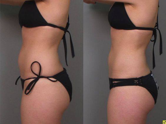 Wellness ™Anti-cellulite Vacuum Massage