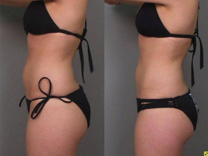 Wellness ™Anti-cellulite Vacuum Massage