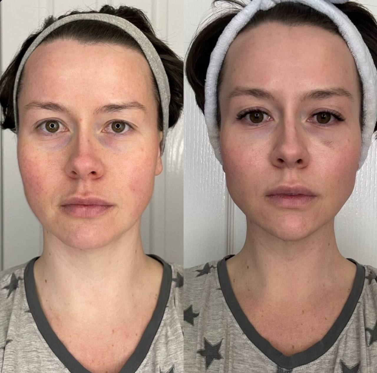 Wellness™ Micro-Toner